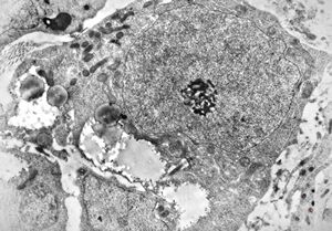 M,12y. | Ewing sarcoma - thorax M,12y. | Ewing sarcoma - thorax